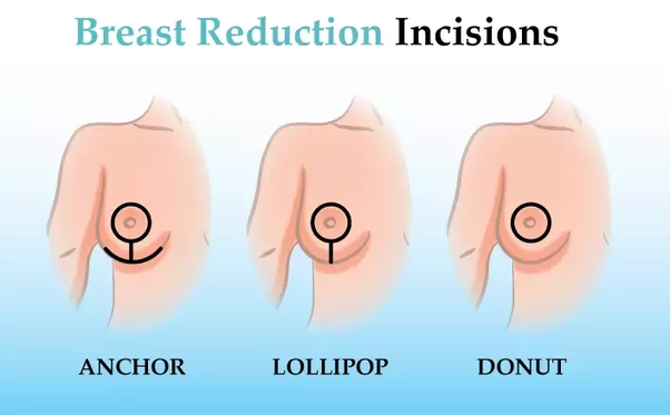 Loss of breast tissue reasons