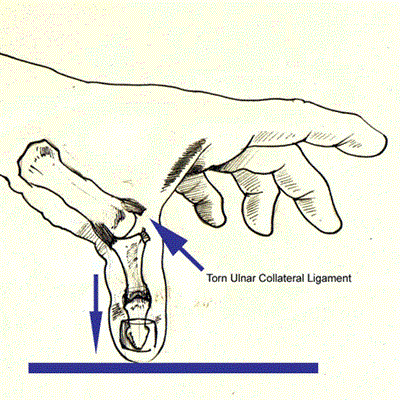 Torn thumb ligament treatment