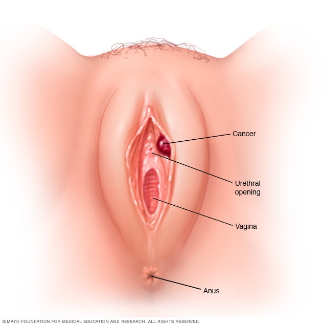 Sore lump inside vagina