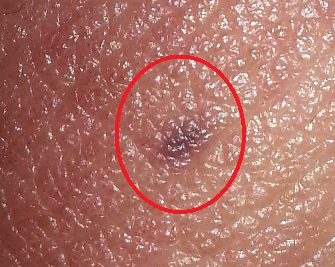 Dark red spots on penis head pictures