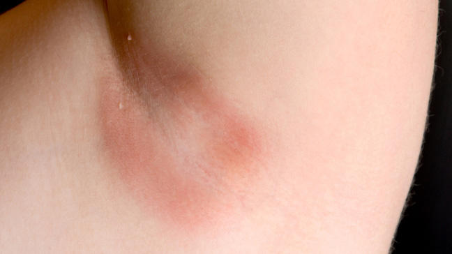 Yeast infection facial rash fever
