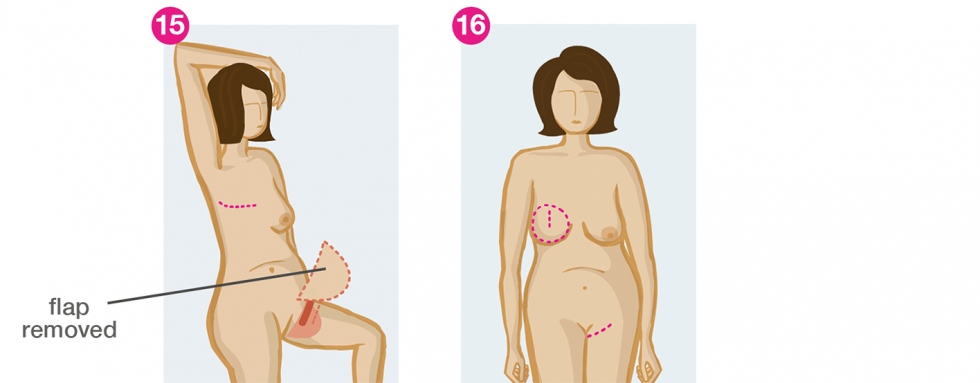 Breast swelling and rupture