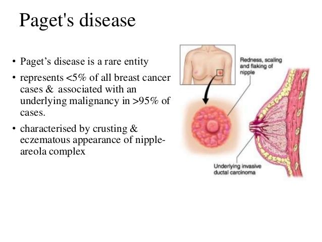 Compare normal breast to pagets disease