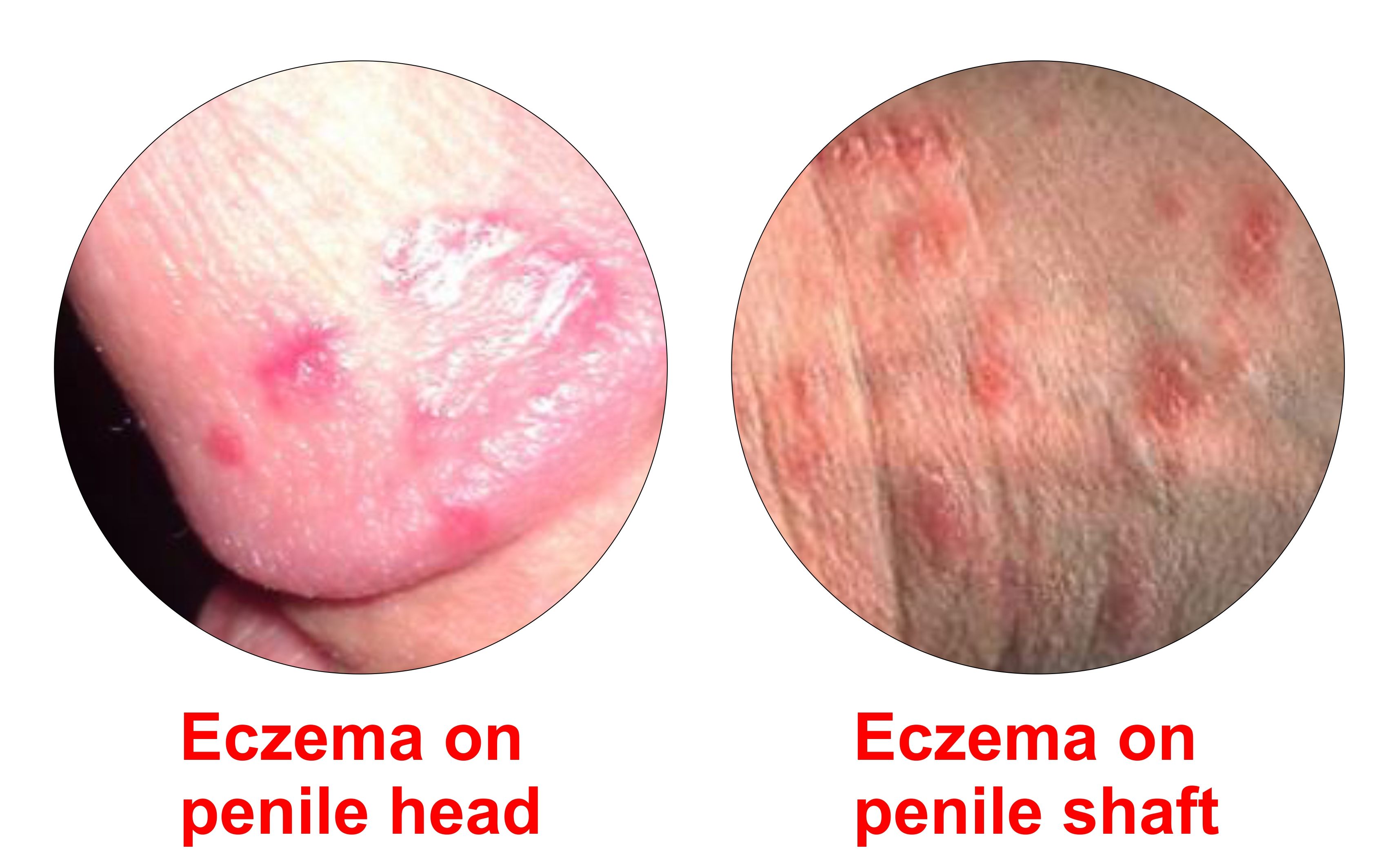 Eczema on penis head