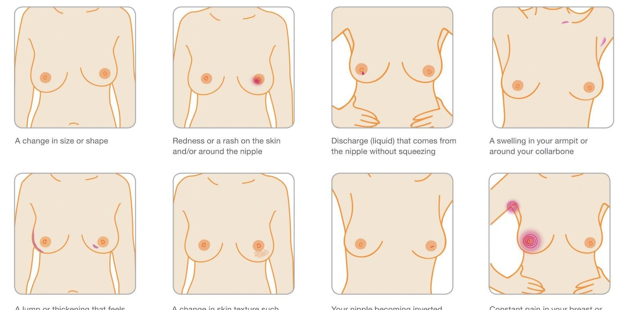 Lump on breast the nipple