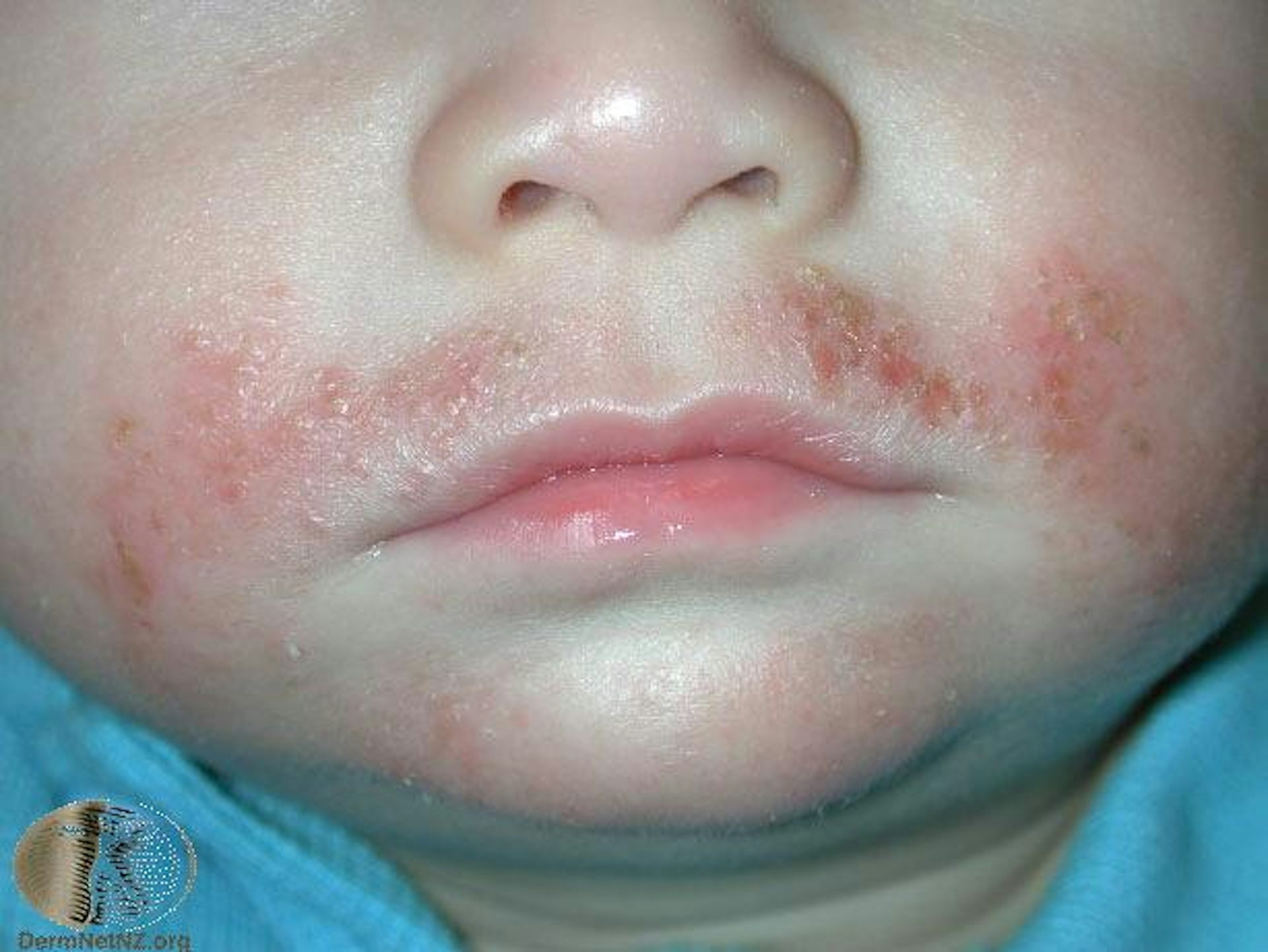 Yeast infection facial rash fever