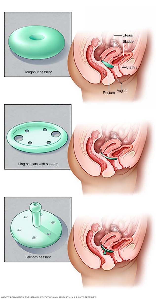 Vaginal pessary insertion