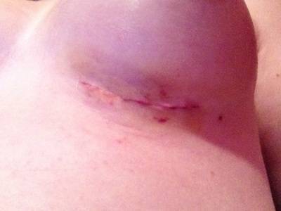 Infection after breast implant
