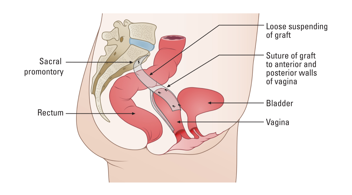 Description of vaginal suspension procedure
