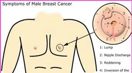 Man breast lump