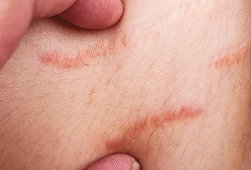 Penis infection scar tissue stretch