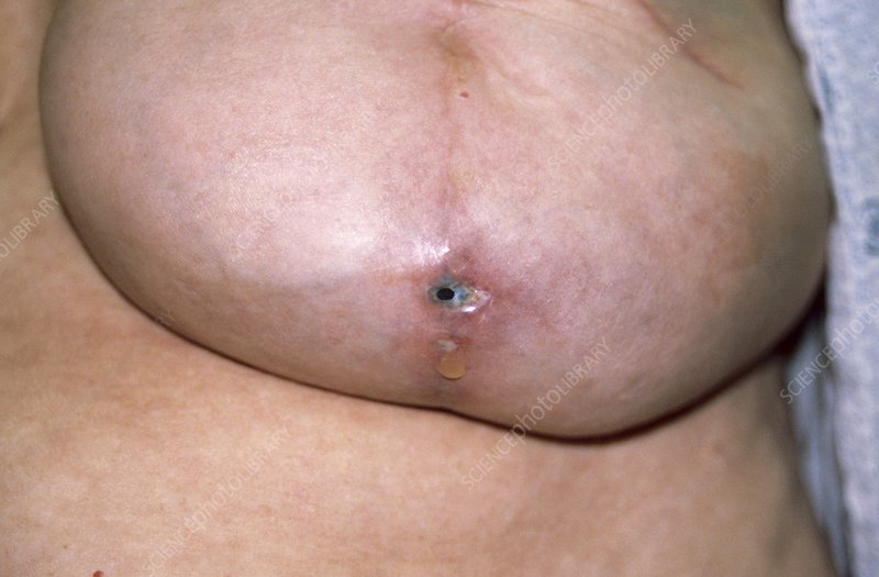 Infection after breast implant