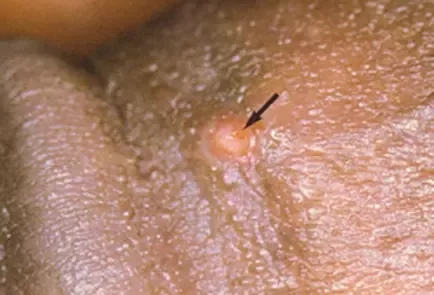Blisters around the vagina