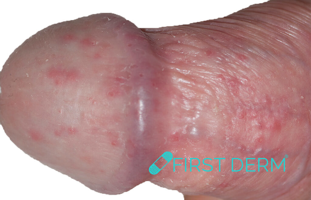 Dark red spots on penis head pictures