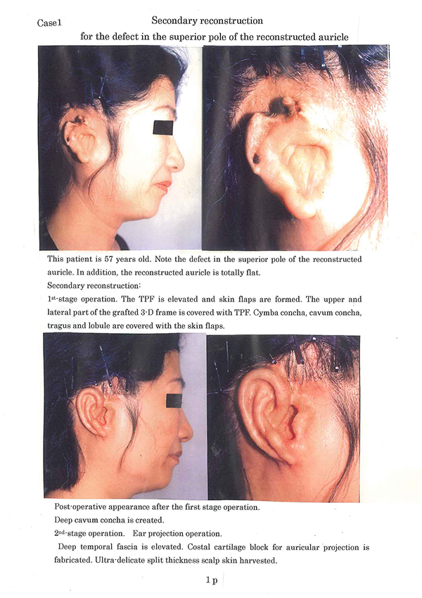 Facial paraylsis reconstructive fl