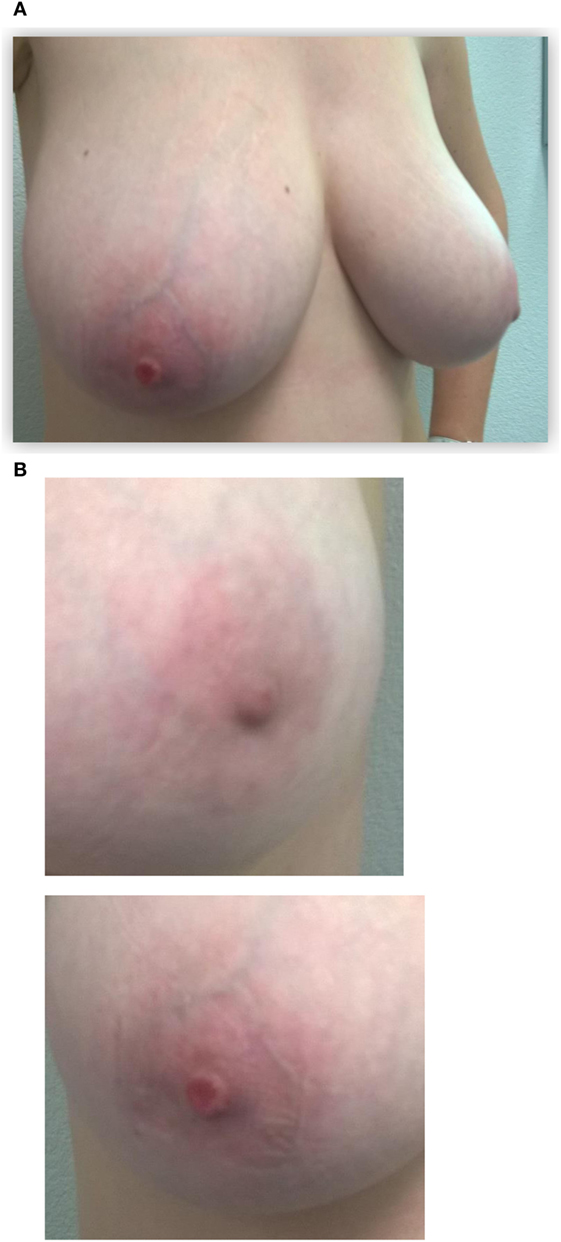 Compare normal breast to pagets disease