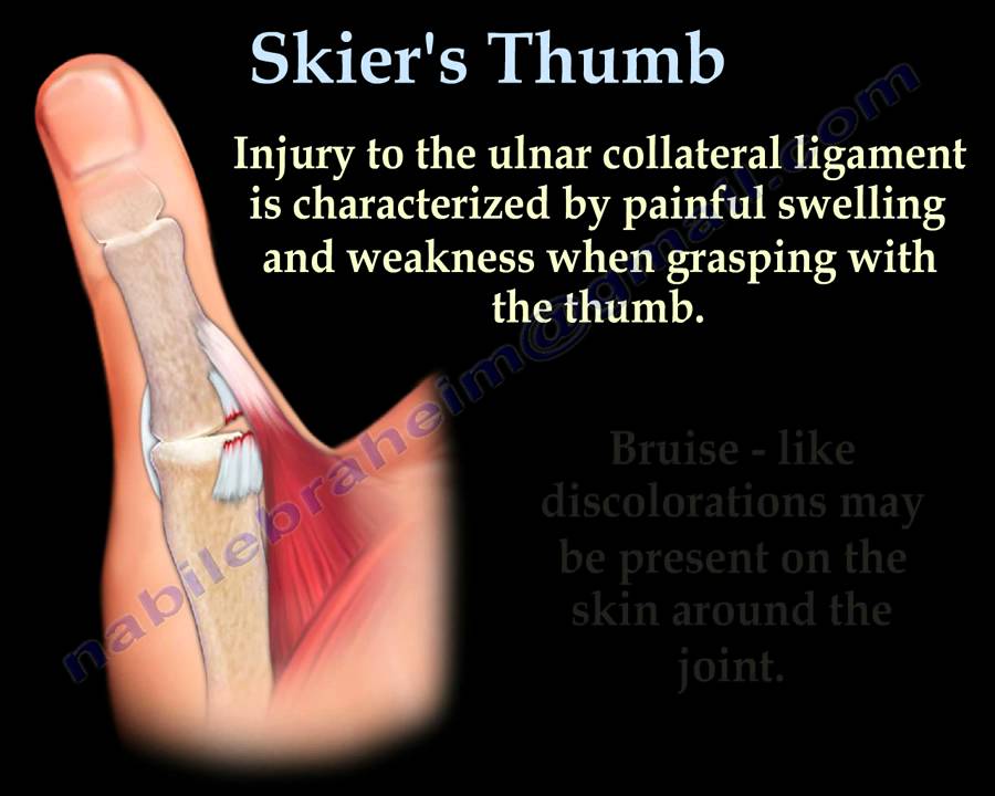 Torn thumb ligament treatment