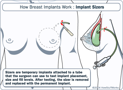 What size implants breast
