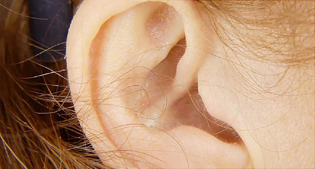 Treatment of adult ear infections