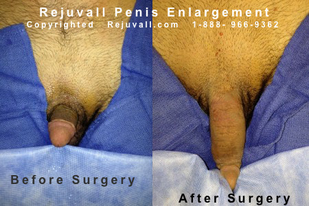Pictures penis before after enlarge an
