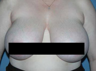 Breast reduction surgery scottsdale