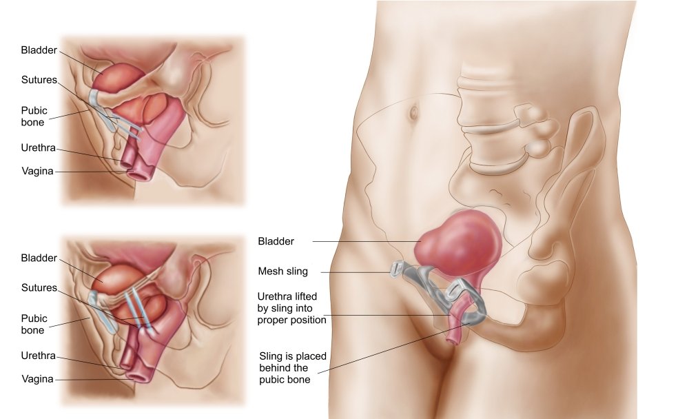 Description of vaginal suspension procedure