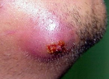 Pictures sebaceous cysts pussy